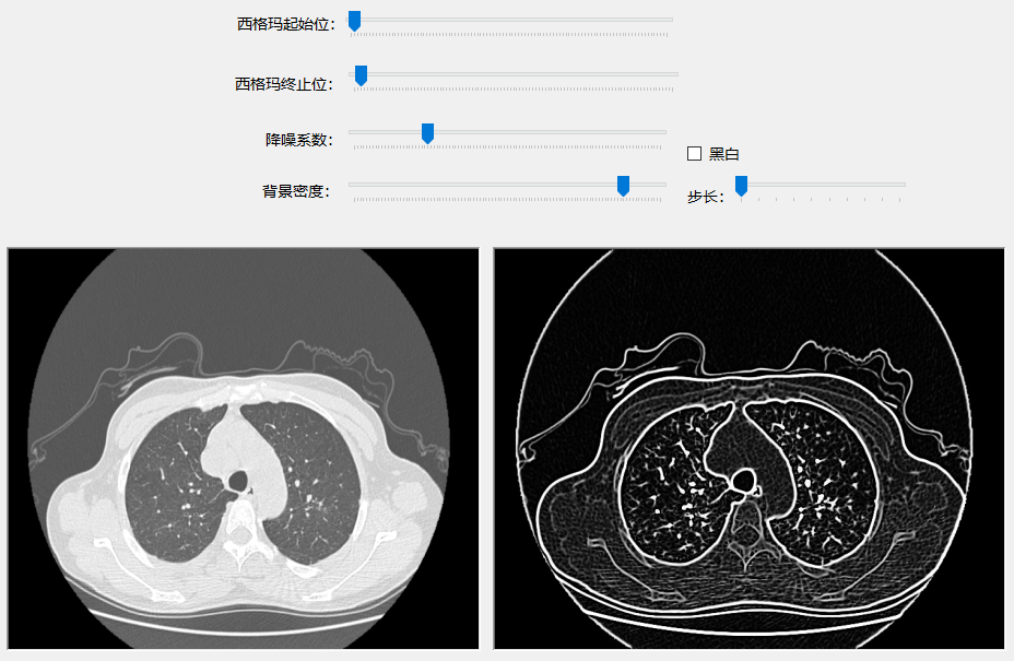 C#处理医学图像(一):基于Hessian矩阵的血管肺纹理骨骼增强对比
