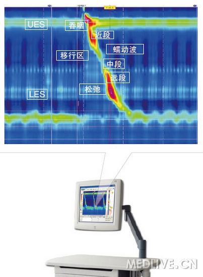 高分辨率食道测压（HRM）第1张